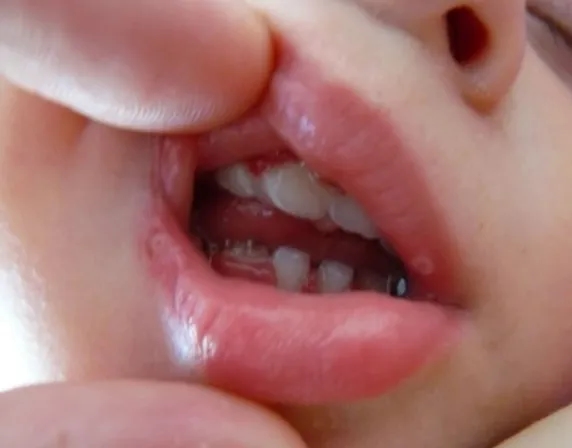 Co na afty u niemowlaka? Skuteczne metody łagodzenia bólu i objawów