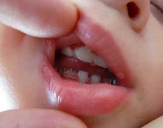 Co na afty u niemowlaka? Skuteczne metody łagodzenia bólu i objawów