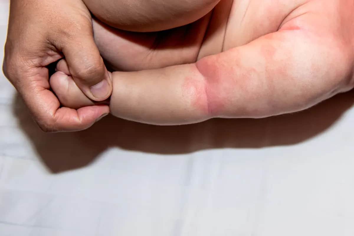 Skuteczne sposoby na azs u niemowlaka – jak złagodzić objawy?