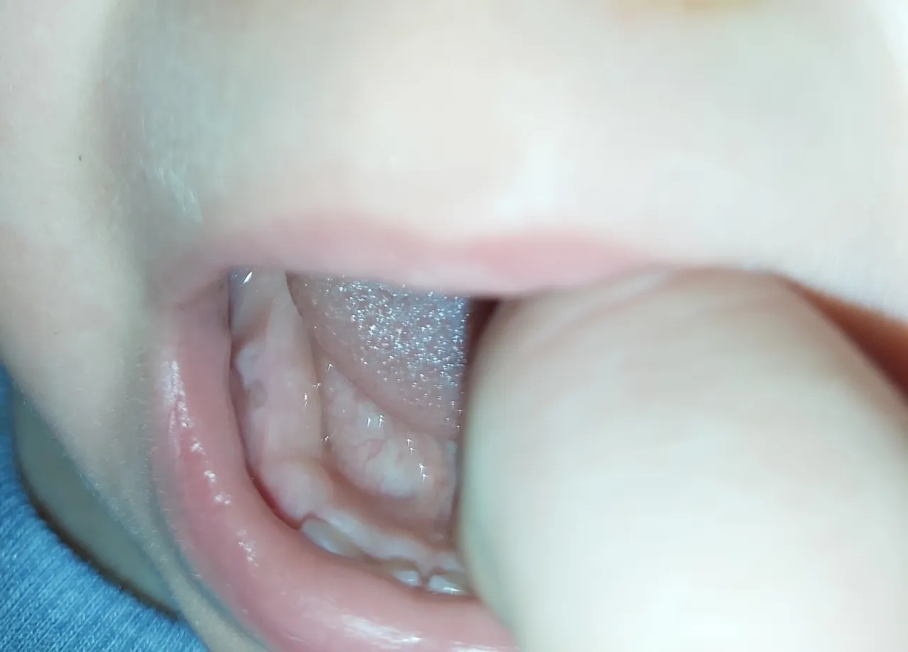 Jak wyglądają wychodzące zęby u niemowlaka - objawy i zmiany w dziąsłach