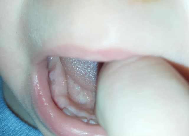 Jak wyglądają wychodzące zęby u niemowlaka - objawy i zmiany w dziąsłach